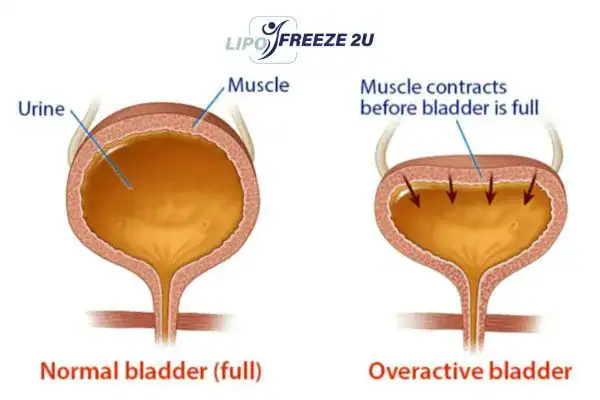 diagram of overactive bladder treatment Brackley