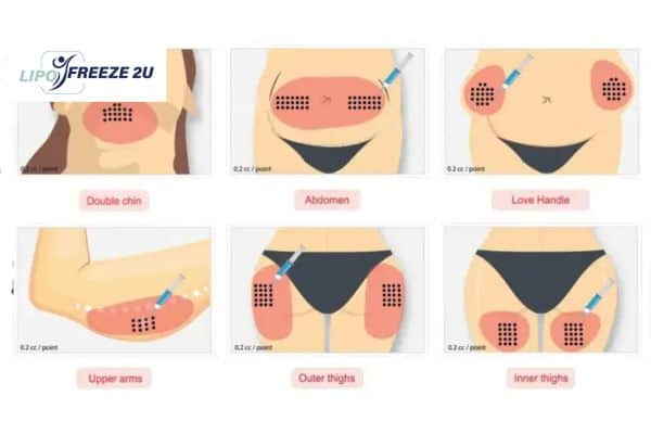 Benefits of Choosing Aqualyx for Fat Reduction Brackley