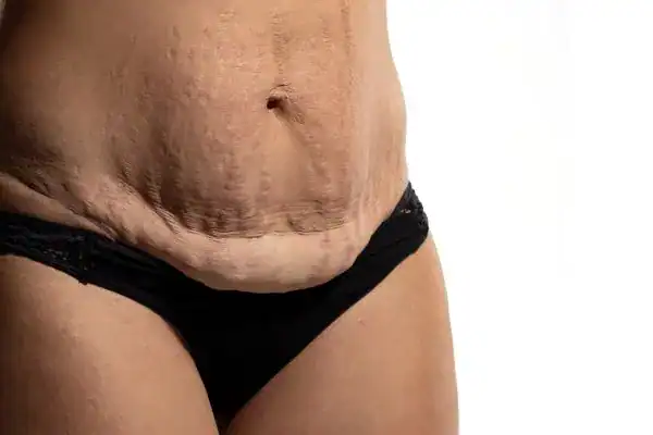 loose skin after weight loss injections Brackley