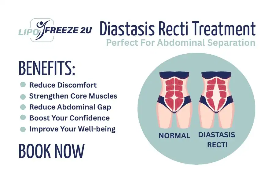Benefits of body toning treatment Brackley for Diastasis recti