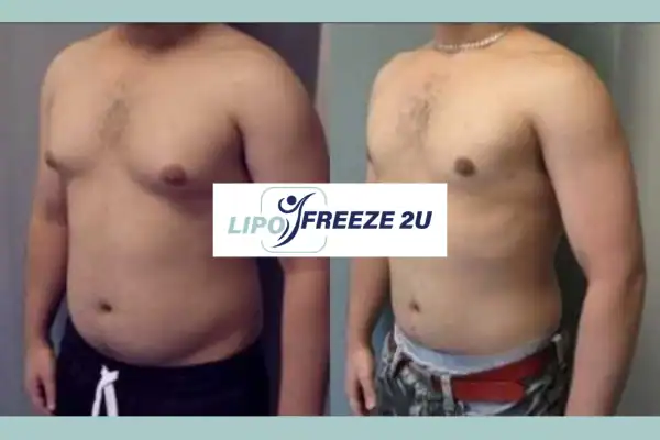 How Long Does It Take to See Results Brackley?