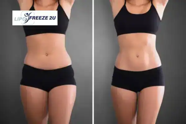 How Can LIPO FREEZE 2U Support Your Post-Pregnancy Body Recovery Brackley?