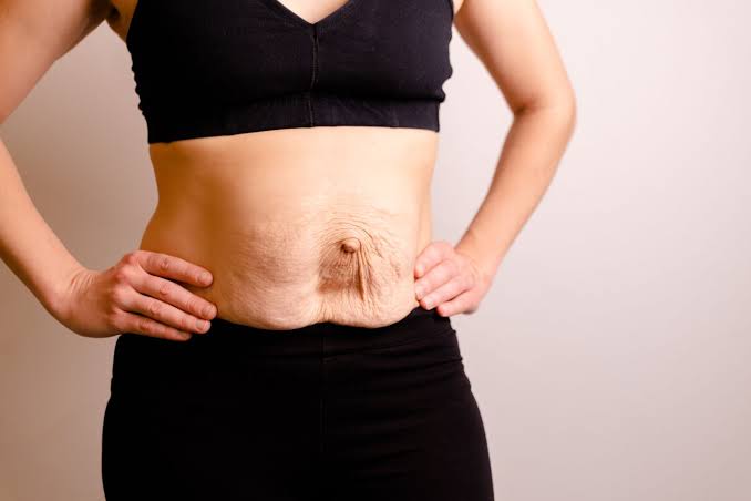 Is Surgery Really the Only Way to Repair Diastasis Recti Brackley?
