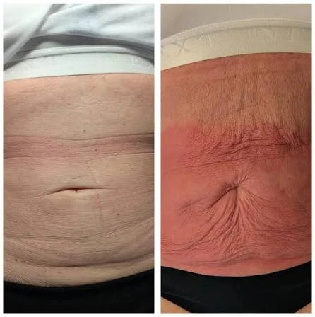 How Does RF Microneedling Improve Crepey, Thin and Uneven Skin Texture Brackley?