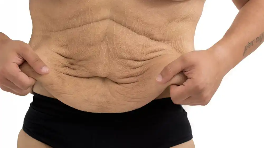 Why Does Weight Loss Medication Leave Some People With Loose or Sagging Skin Brackley?